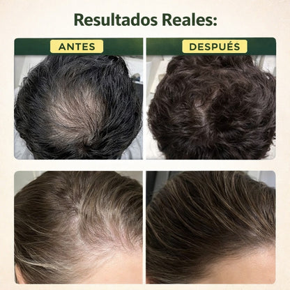 HairVita Pro Anticaída 200 ML - Oferta especial 2X1